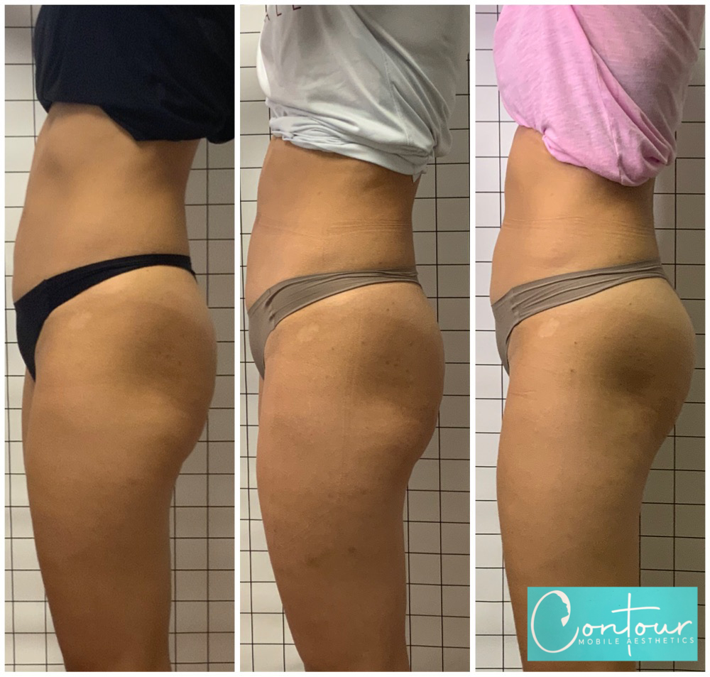 PHYSIQ Body Contouring Buy two get one free