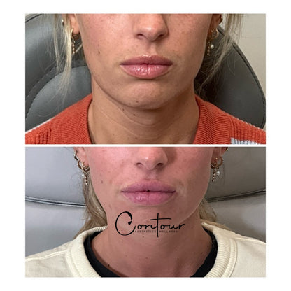 Mini Lip filler