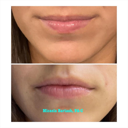 Buy 50u botox, get 20u free