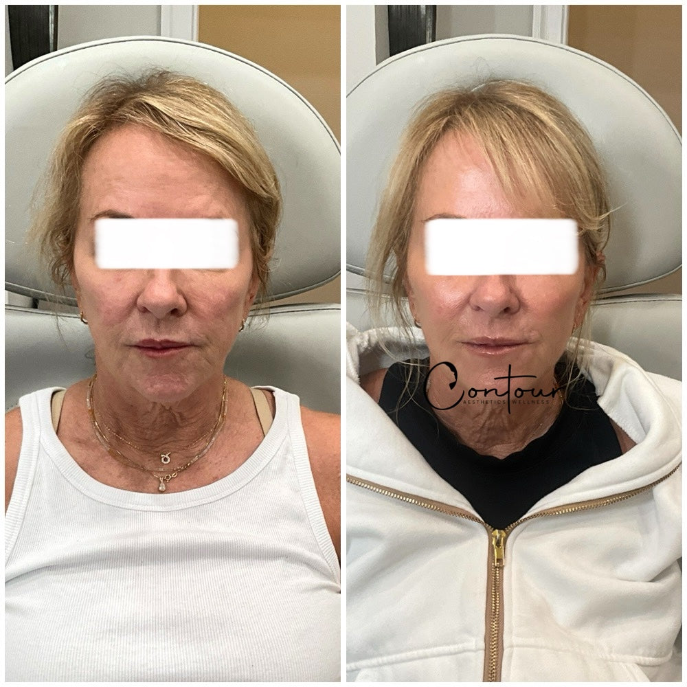 Skinvive injectable moisturizer