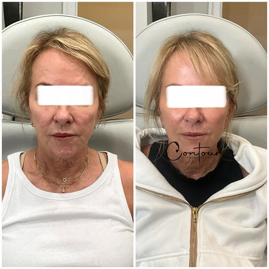 Skinvive injectable moisturizer