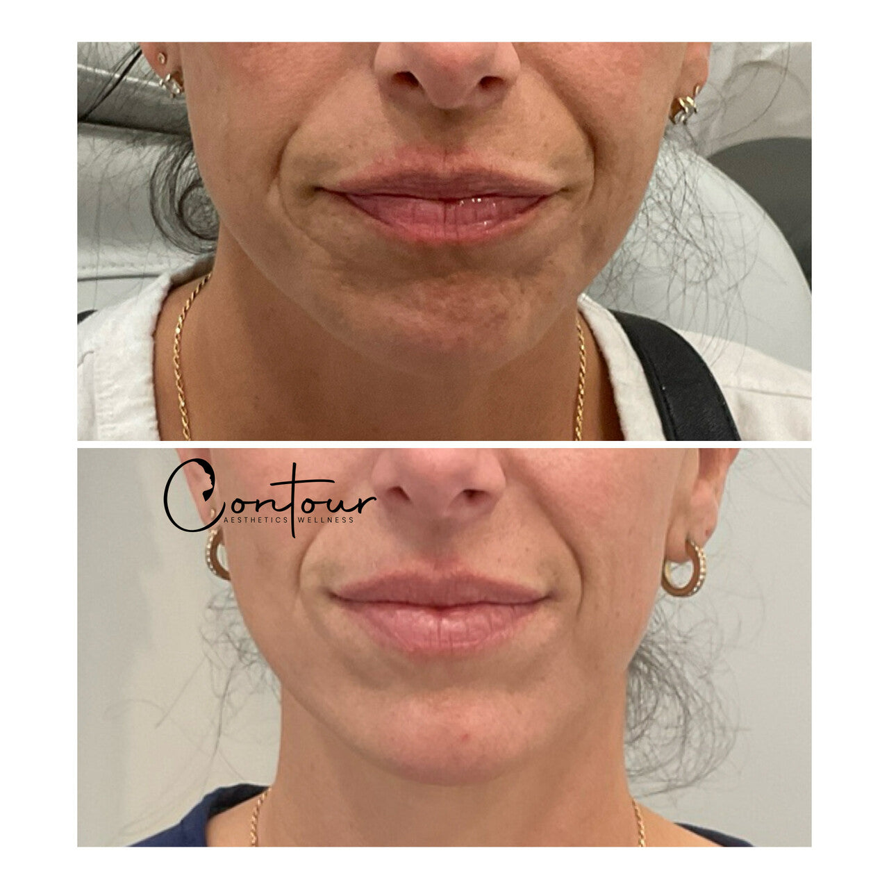 Buy 50u botox, get 20u free