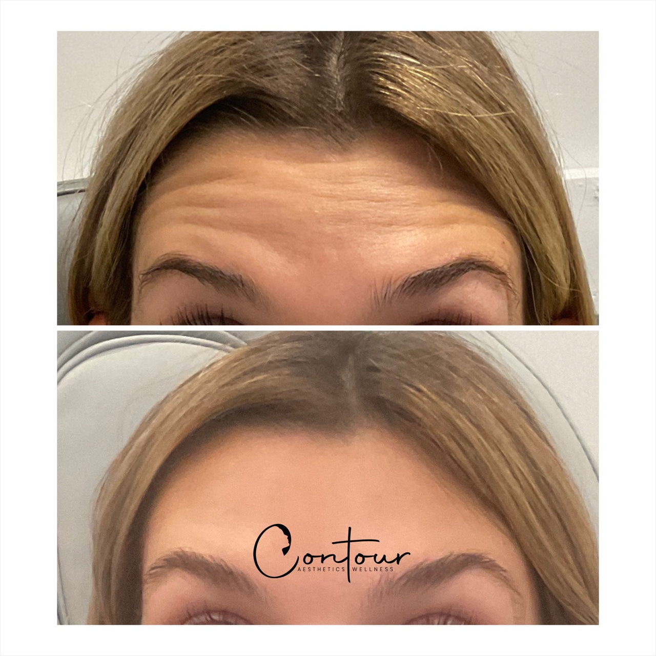 Buy 50u botox, get 20u free