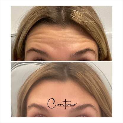 Buy 50u botox, get 20u free