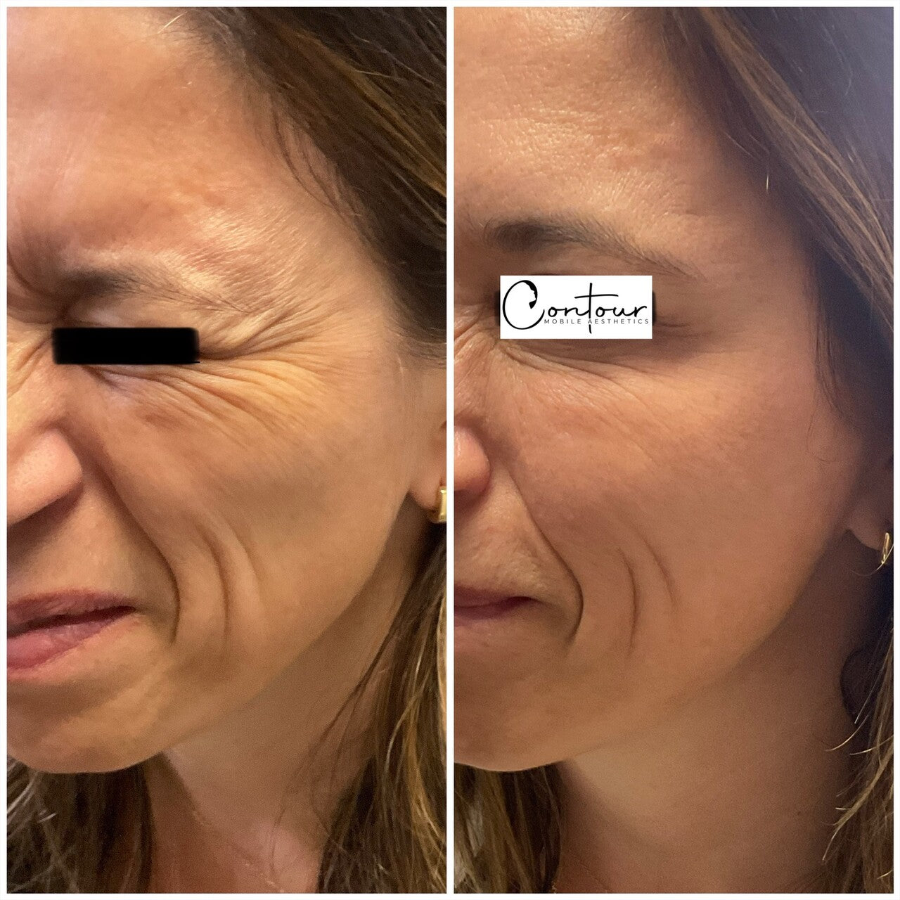 Buy 50u botox, get 20u free