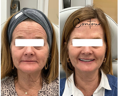 Buy 50u botox, get 20u free