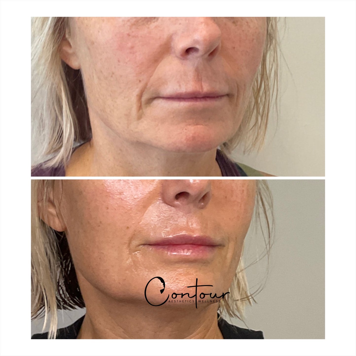 Mini Lip filler