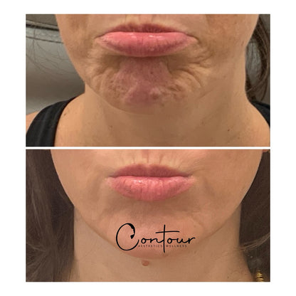 Buy 50u botox, get 20u free