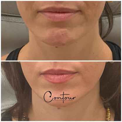 Buy 50u botox, get 20u free