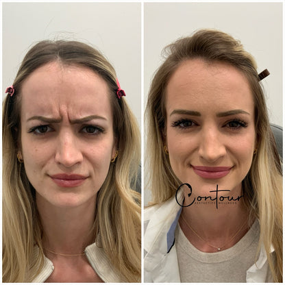 Buy 50u botox, get 20u free