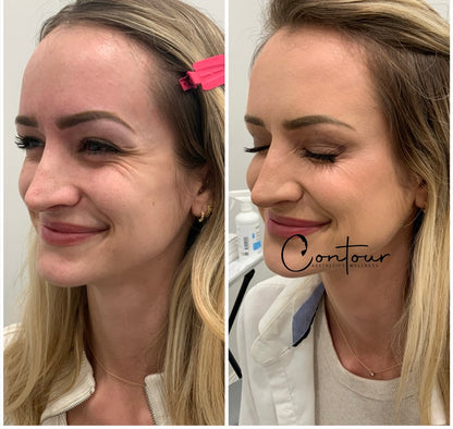Buy 50u botox, get 20u free