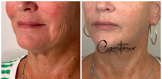 Fine line filler treatment