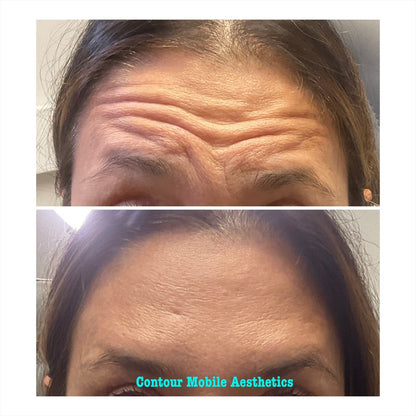 Buy 50u botox, get 20u free